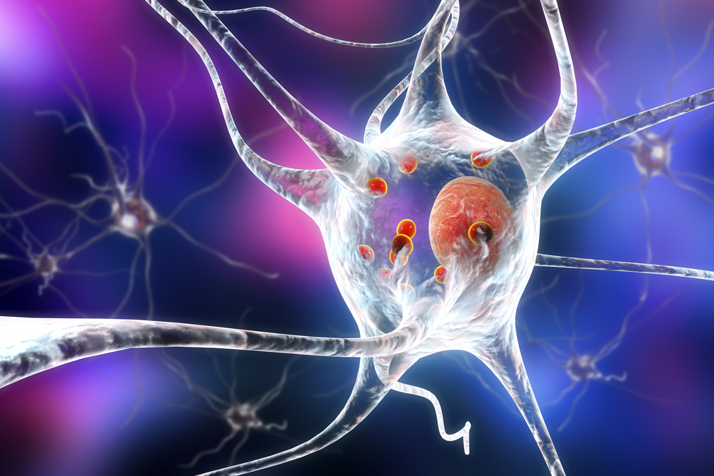 Neuroprosthesis for Parkinson’s Disease: Breakthrough Treatment in Monkeys and Human Patient